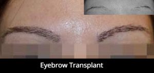 eyebrow-hair-transplant