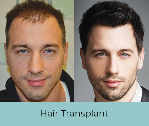 Best Hair Transplant Clinic in Delhi Best Hair Transplant Clinic in Delhi
