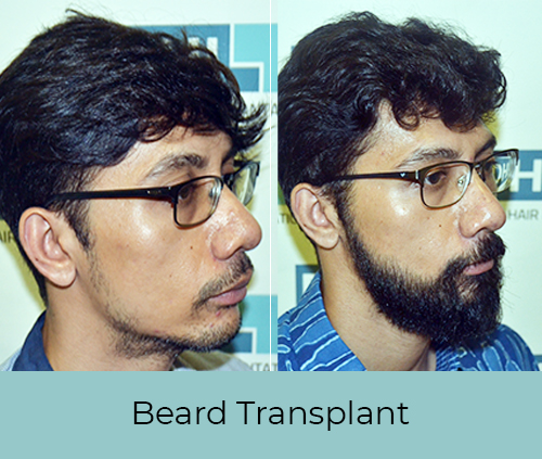 service2 beard-transplant