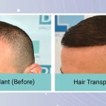 Hair Transplantation for Temporal Hair Loss