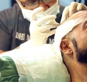 Is hair transplant a permanent solution