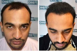 hair transplant treatment in Mexico 