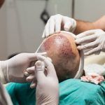 Hair Transplants for Sideburn Restoration