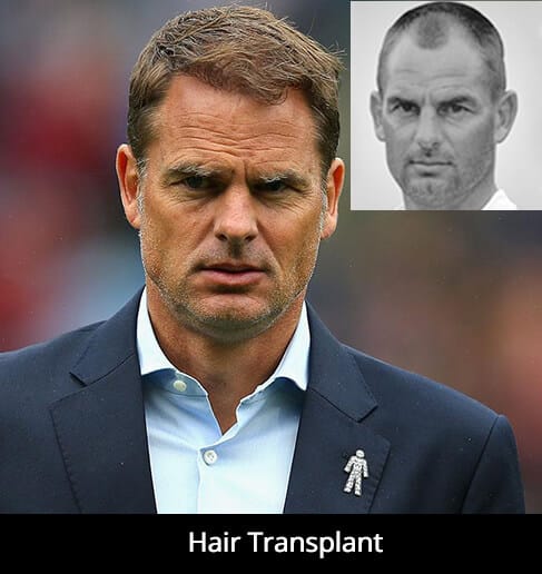 men hair Transplant