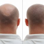 Cost Of A DHI Hair Transplant in Panama