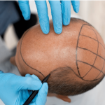 Hair Transplantation for Face Scarring