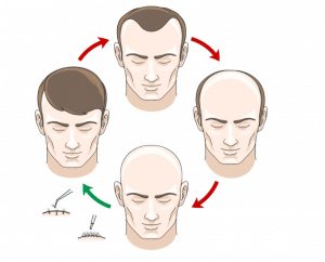 Hair Transplantation for Face Scarring