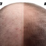 Effective Hair Transplant for Hormonal Baldness