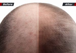 Effective Hair Transplant for Hormonal Baldness
