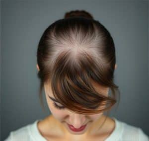 hair transplantation for androgenic-alopecia in women