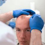 Hair Transplants Treatment for Gender Transition