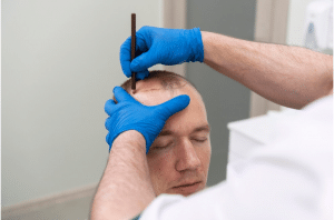 Hair Transplantation for Androgenic Alopecia in Women