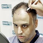 Best Hair Transplant Technique in Sydney, Australia, DHI – Direct Hair Implantation