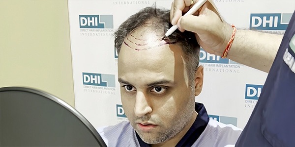 Best Hair Transplant Technique in Sydney, Australia, DHI – Direct Hair Implantation