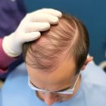 hair transplant for managing hair loss from stress