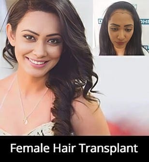 Female Hair Transplant