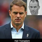 Hair Transplant Cost In India