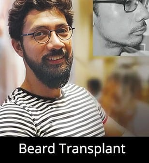 Beard Transplant