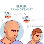 How To Start a Hair Transplant Business or Clinic