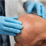 DHITM is the Best Hair Transplant Technique in India