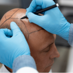 Best Hair Transplant Clinic in Queretaro