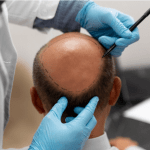 Hair Transplant in Hyderabad, India