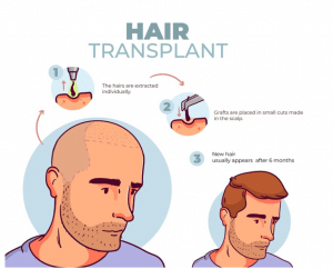 Hair Transplant 