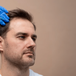 Hair transplant