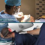 DHI Hair transplant Versus Robotic FUE Hair Transplant Procedure