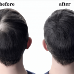 Hair Transplant