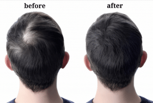 Hair Transplant