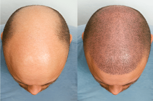 Hair Loss Treatments results