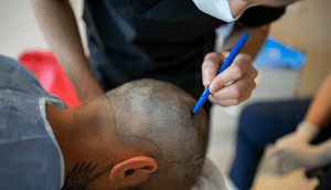 Hair Transplant Cost in India