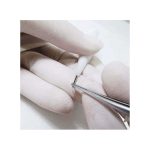 Hair Transplant