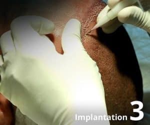 Hair Transplant 
