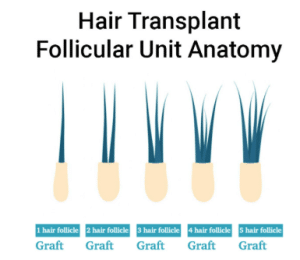 hair transplant