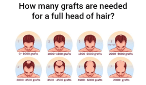hair transplant