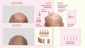 best hair transplant procedure in the world best hair transplant procedure in the world