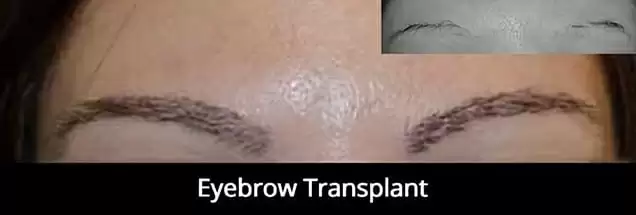 eyebrow-transplant
