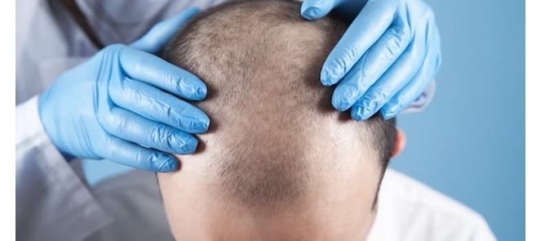 10000 Hair Transplant Cost in India