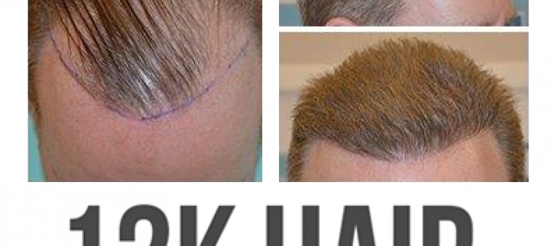 12,000 plus follicles implanted for a complete transformation, in just 11 hours!