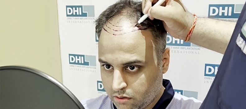 Best Hair Transplant Technique in Sydney, Australia, DHI – Direct Hair Implantation