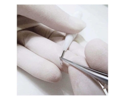 The Role of Advanced Implanters in DHI Hair Transplant Procedures