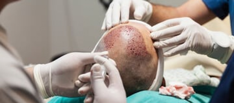 Hair Transplants for Sideburn Restoration