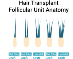 How to Estimate the Number of Grafts Required for Your Hair Transplant