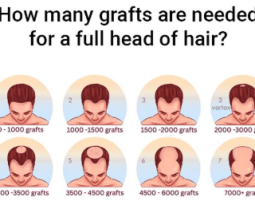 How to Estimate the Number of Grafts You Need for a Hair Transplant Treatment