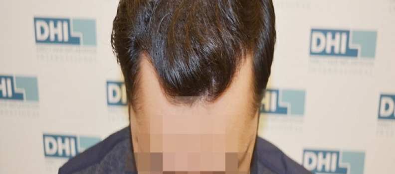 How a 25-year-old got his confidence back with DHI Hair Transplant Technique!