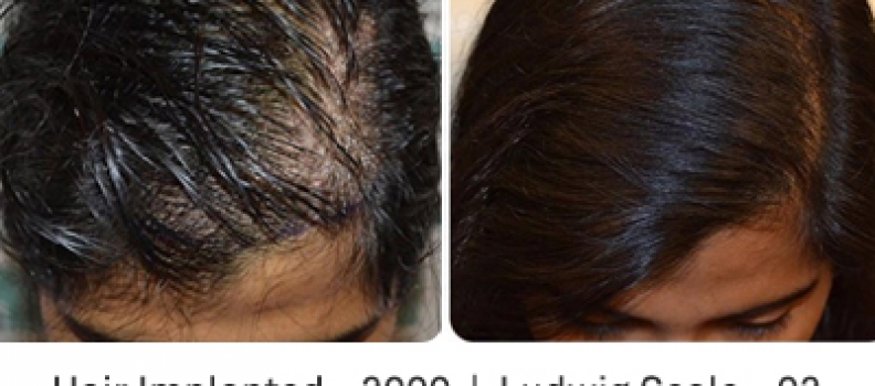 Natural, fair density result from a female hair transplant case