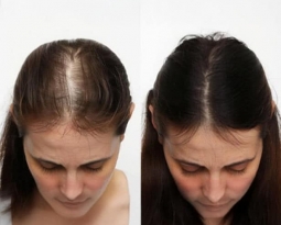 Female Hair Loss Treatment: Restore Your Hair with Transplantation