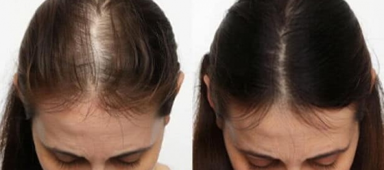 Female Hair Loss Treatment: Restore Your Hair with Transplantation